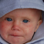 US Measles Outbreak - Case Numbers Broke All Records